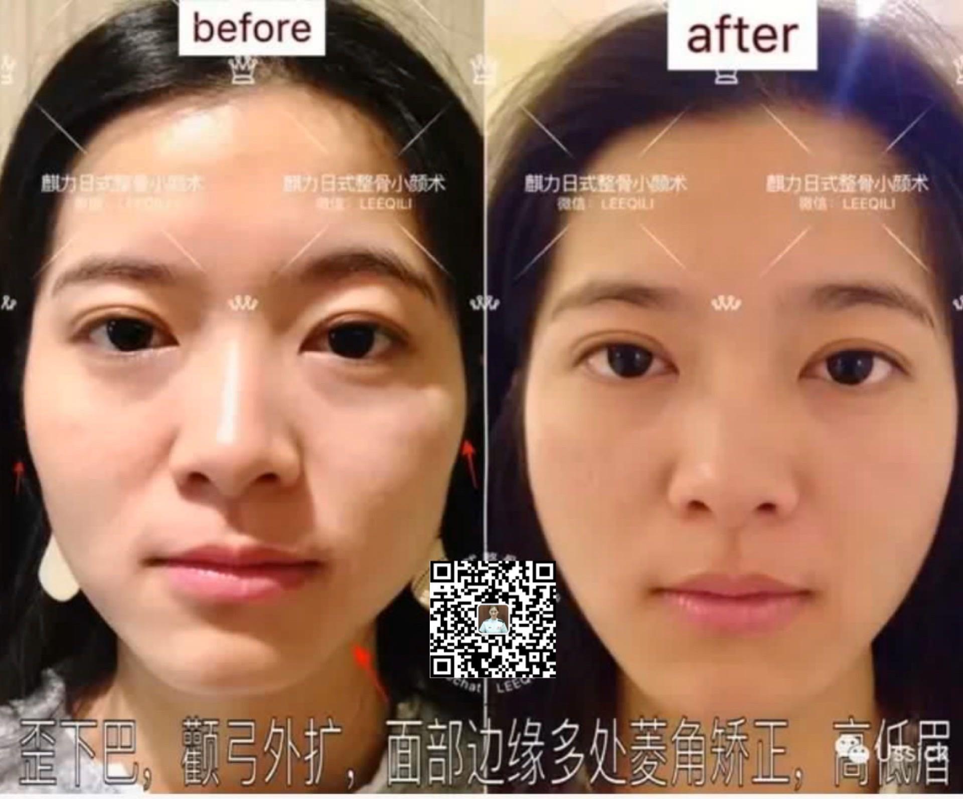 face slimming 整骨小颜术,徒手整形