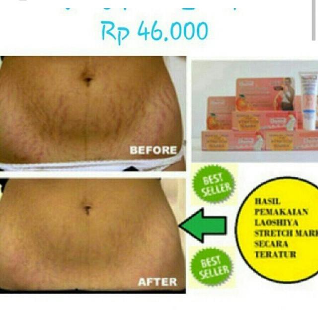 Laoshiya Stretch Mark Kesehatan Kecantikan Di Carousell