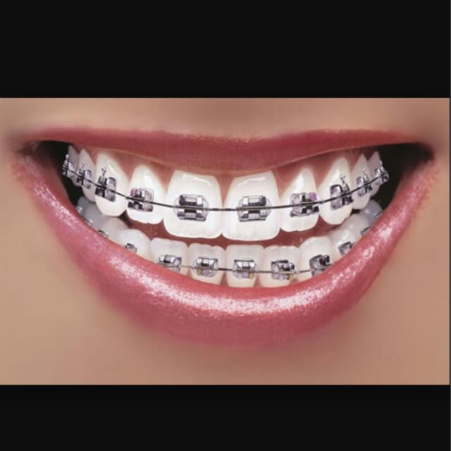 Wallpaper Fake Braces In Black Women S Fashion On Carousell For iPhone Free