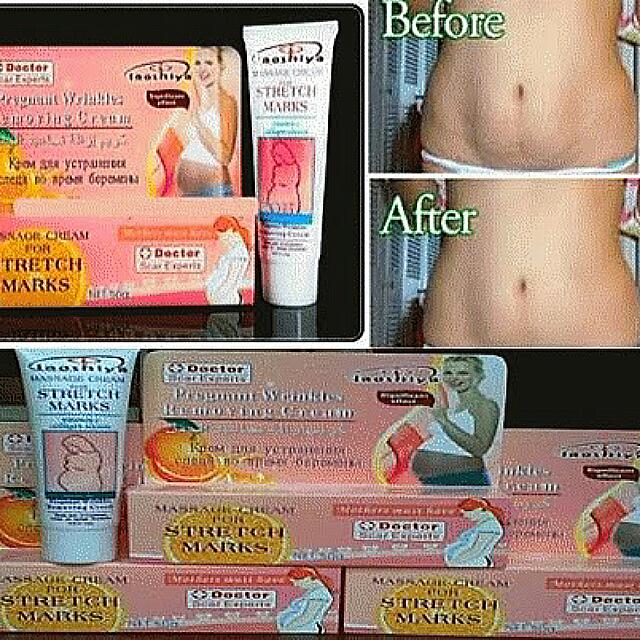 Laoshiya Cream Remove Stretch Mark Cellulite Health Beauty On Carousell