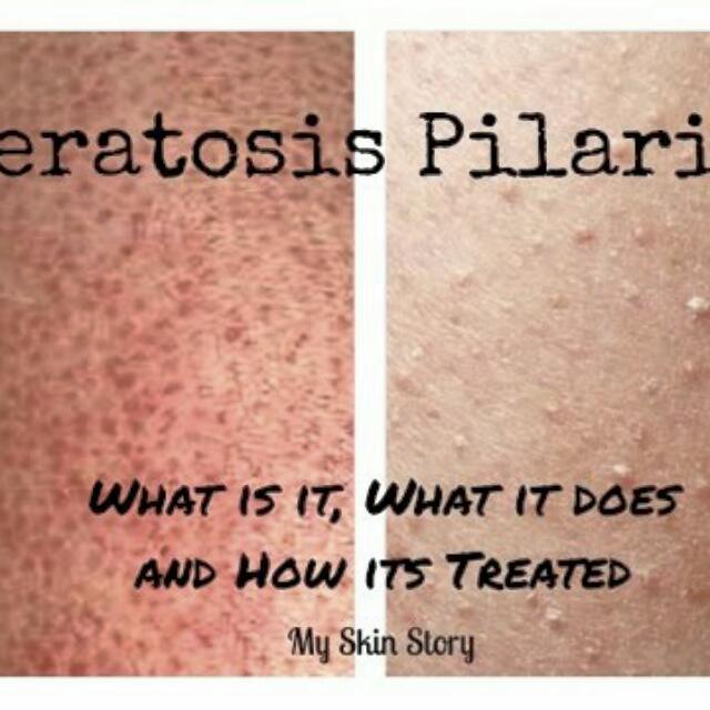 15 UREA (Keratosis Pilaris Life Saver), Women's Fashion, Dresses