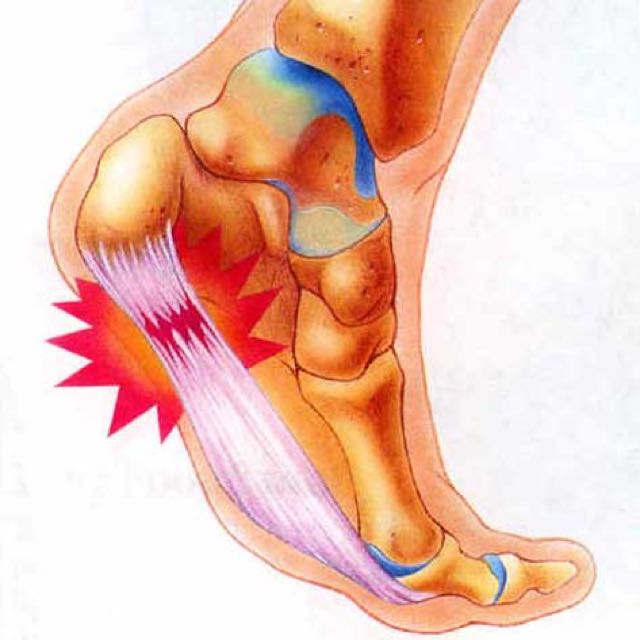 足底筋膜炎 超聲深層筋膜治療 其他 其他 Carousell