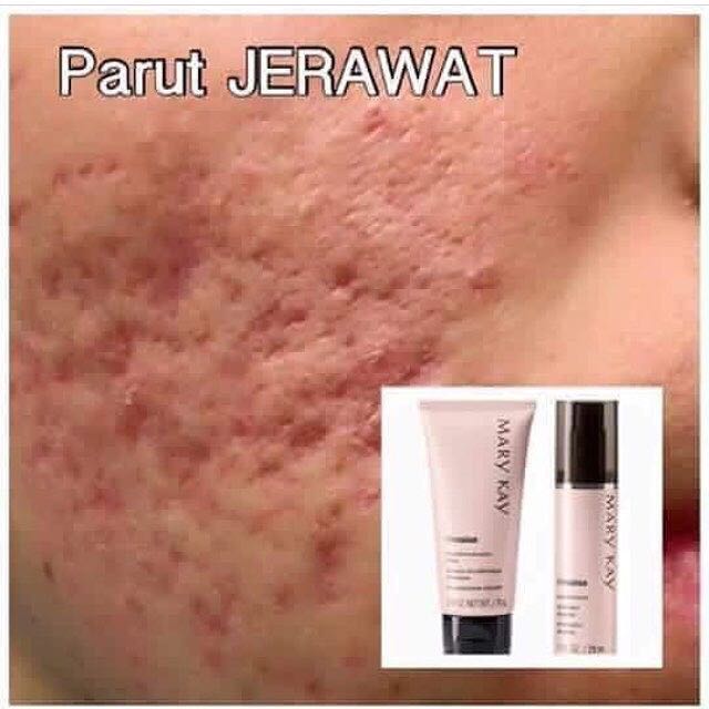 Ubat Jerawat Dan Parut Di Watson Berubat T