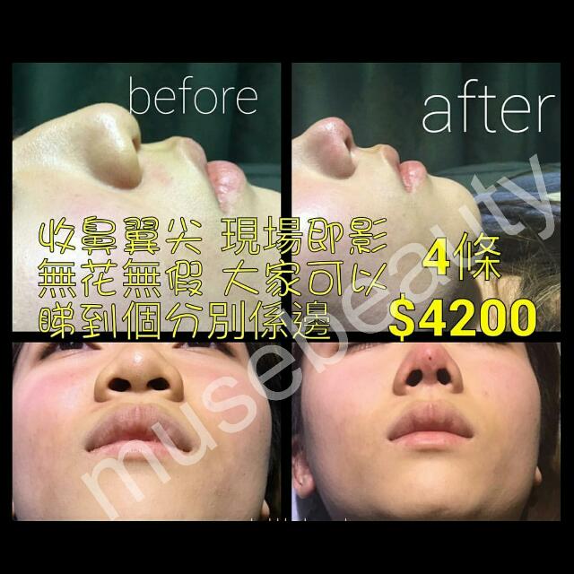 唔洗 鼻影 即時埋線 高鼻 收鼻翼, 美容&個人護理, 健康及美容 - 皮膚護理, 面部 - 面部護理 - Carousell