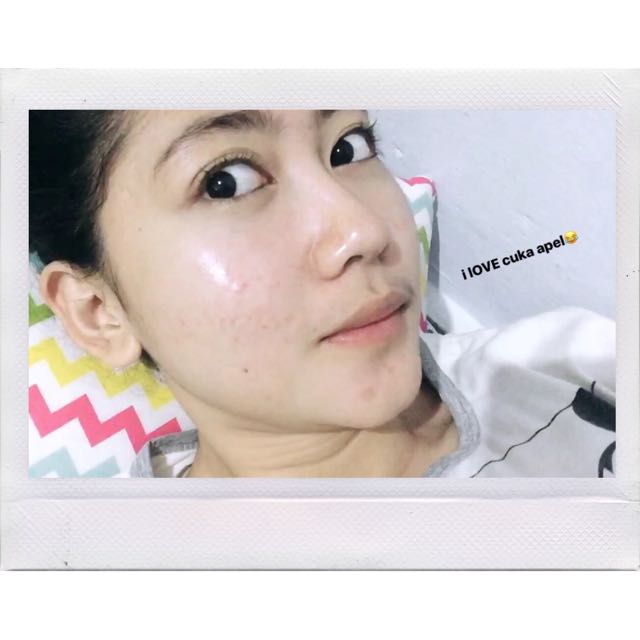 Testimoni Cuka Apel Kesehatan Kecantikan Kulit Sabun Tubuh Di Carousell