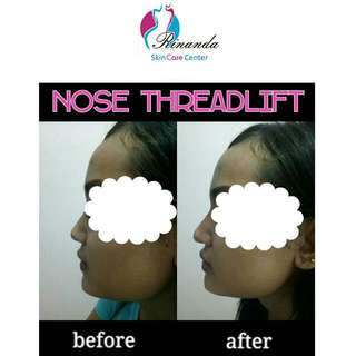 Tanam Benang Hidung