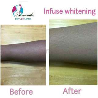 Infuse Whitening