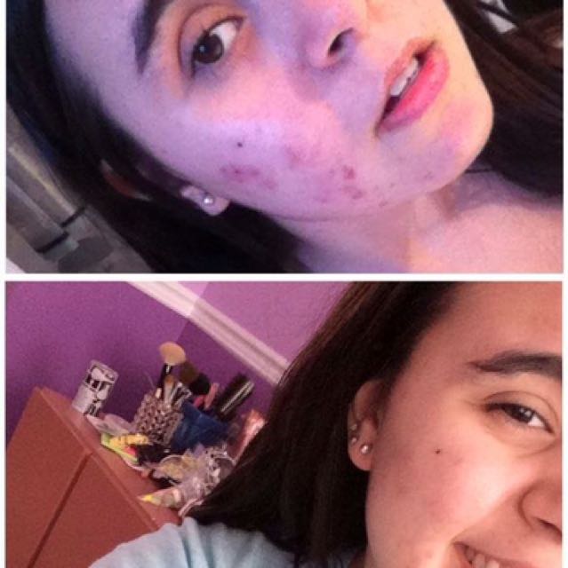 Aloette Aloeclear Anti Acne Skin Care Health Beauty Skin Care On Carousell