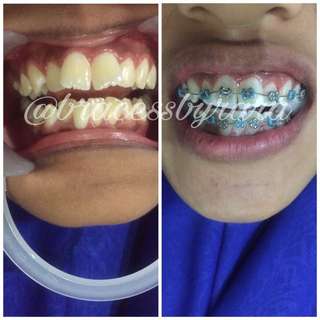 Affordable Braces Gigi For Sale Health Beauty Carousell Malaysia