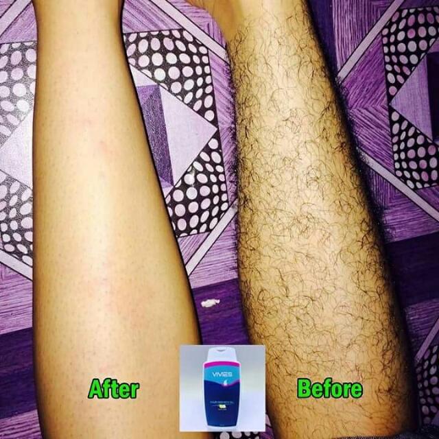 Vivies Hair Removal Cream Health Beauty Skin Bath Body On Carousell
