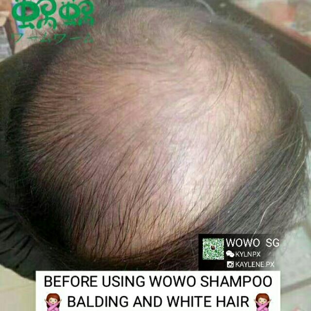 Wowosg For Balding Hair Loss Dandruff Health Beauty