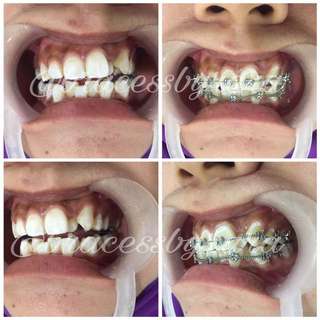 Affordable Braces Gigi For Sale Health Beauty Carousell Malaysia