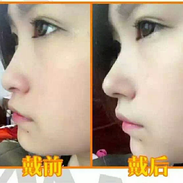 Rhinoplasty 3d High Increased The Nose Stealth Set Health