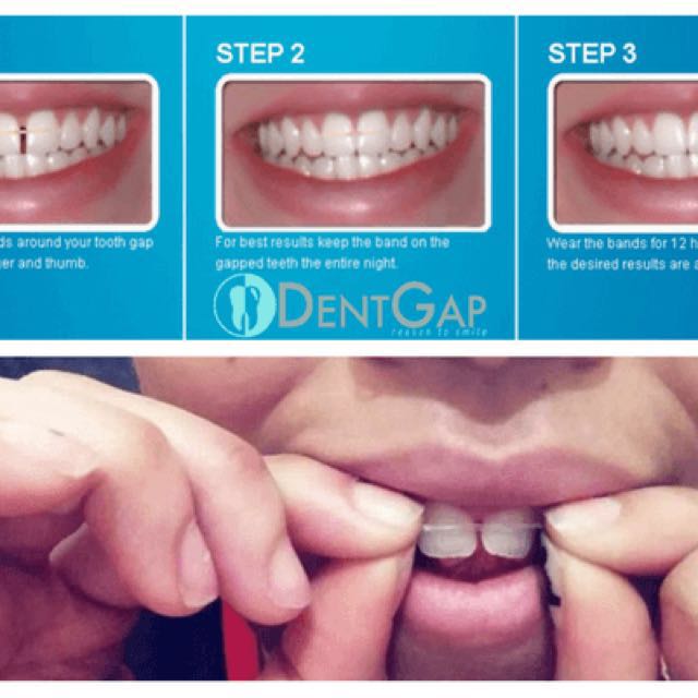 Teeth Gap Bands, Beauty & Personal Care, Face, Face Care on Carousell