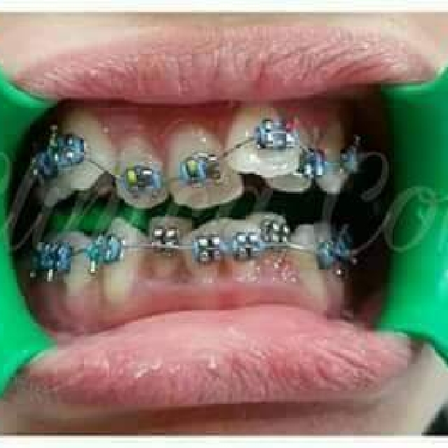 affordable braces in laguna (Category: Looking For) located in Santa Rosa. Submitted by gladypie (Listing ID 127586986, Image 1). Description: 5k downpayment Low monthly installment Lots of freebies Visit us for free consultation Binan branch B5 L35 Golden City Canlalay Binan Laguna (infront of basketball court) MWF 6:00pm to 9:00pm By appointment 09228662110 Sta Rosa Branch Laguna Industrial Health Clinic Bldg. National Road Pulong Sta Cruz Sta 