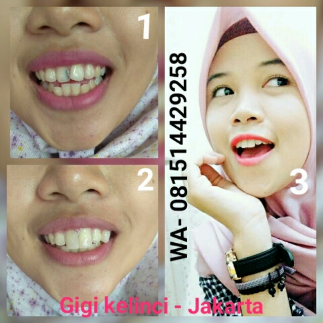 Yang Harus Anda Ketahui Jika Ingin Lakukan Perawatan Gigi Kelinci