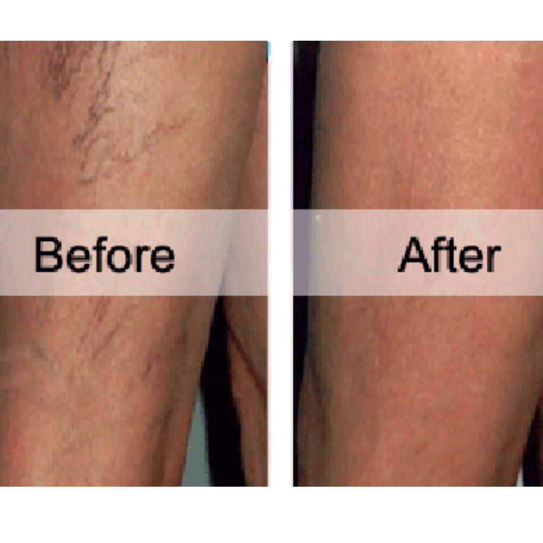 Original Hirudoid cream, Beauty & Personal Care, Bath & Body, Body Care