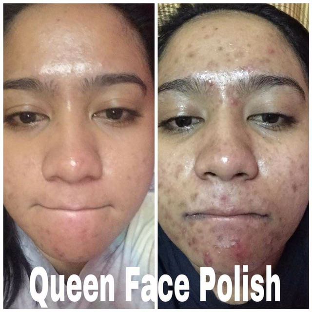Queen Face Polish Treatment Health Beauty Skin Bath Body On Carousell