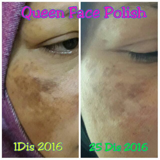 Queen Face Polish Treatment Health Beauty Skin Bath Body On Carousell