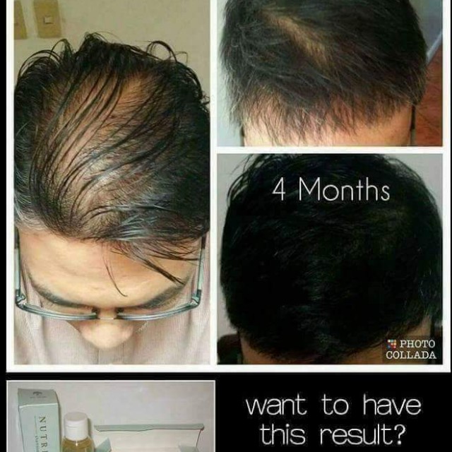 Thinning Hair And Hairfall Health Beauty Hair Care On Carousell