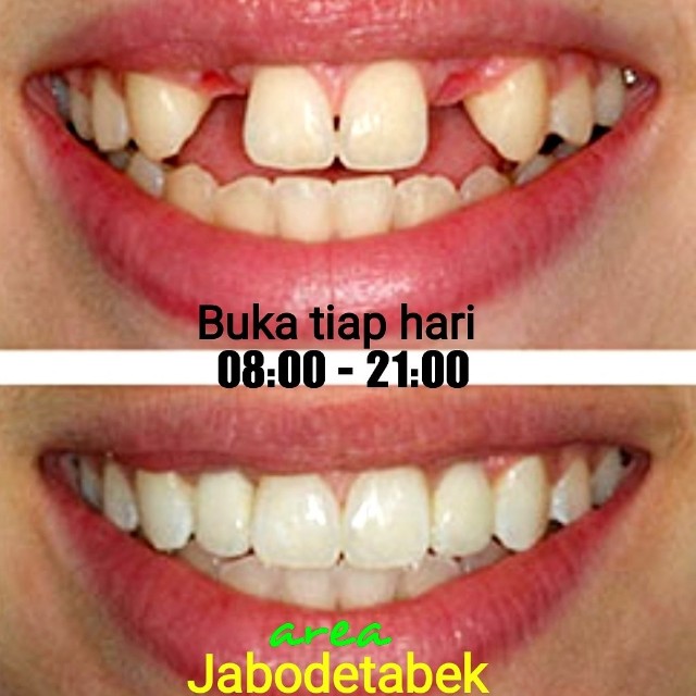 Biaya Gigi tiruan | Polident®