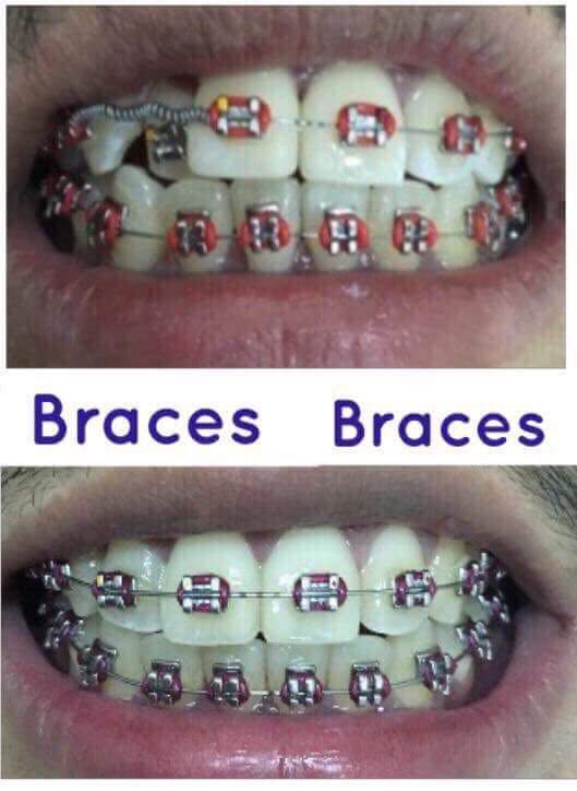 Dental Braces And Fixed Bridges Health Beauty Skin Bath Body On Carousell