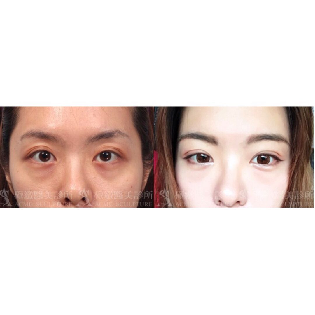 how to get rid of ptosis without surgery