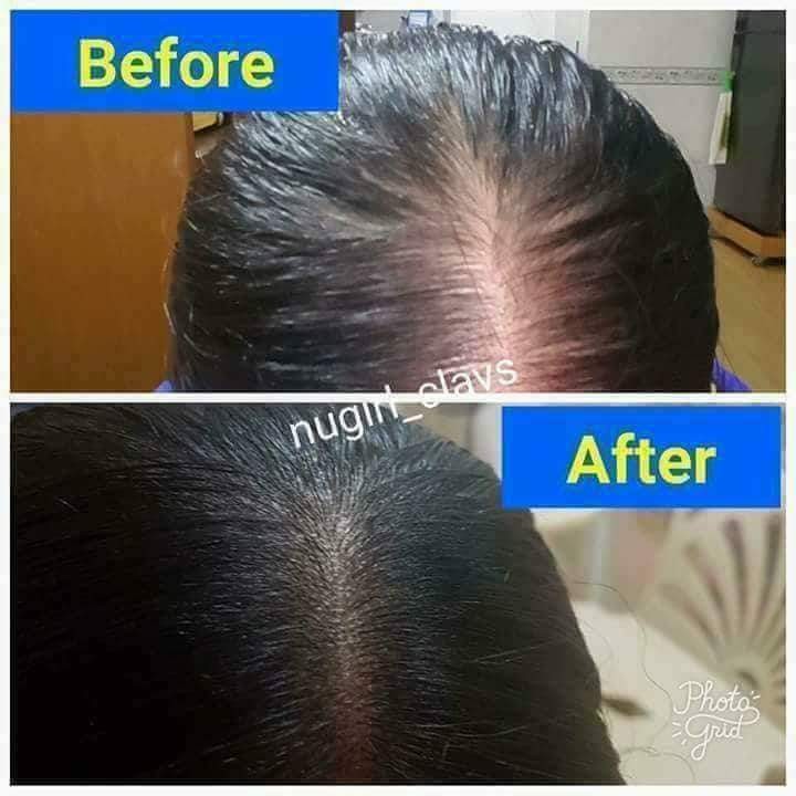 Bad Hairfall And Thinning Health Beauty Hair Care On Carousell