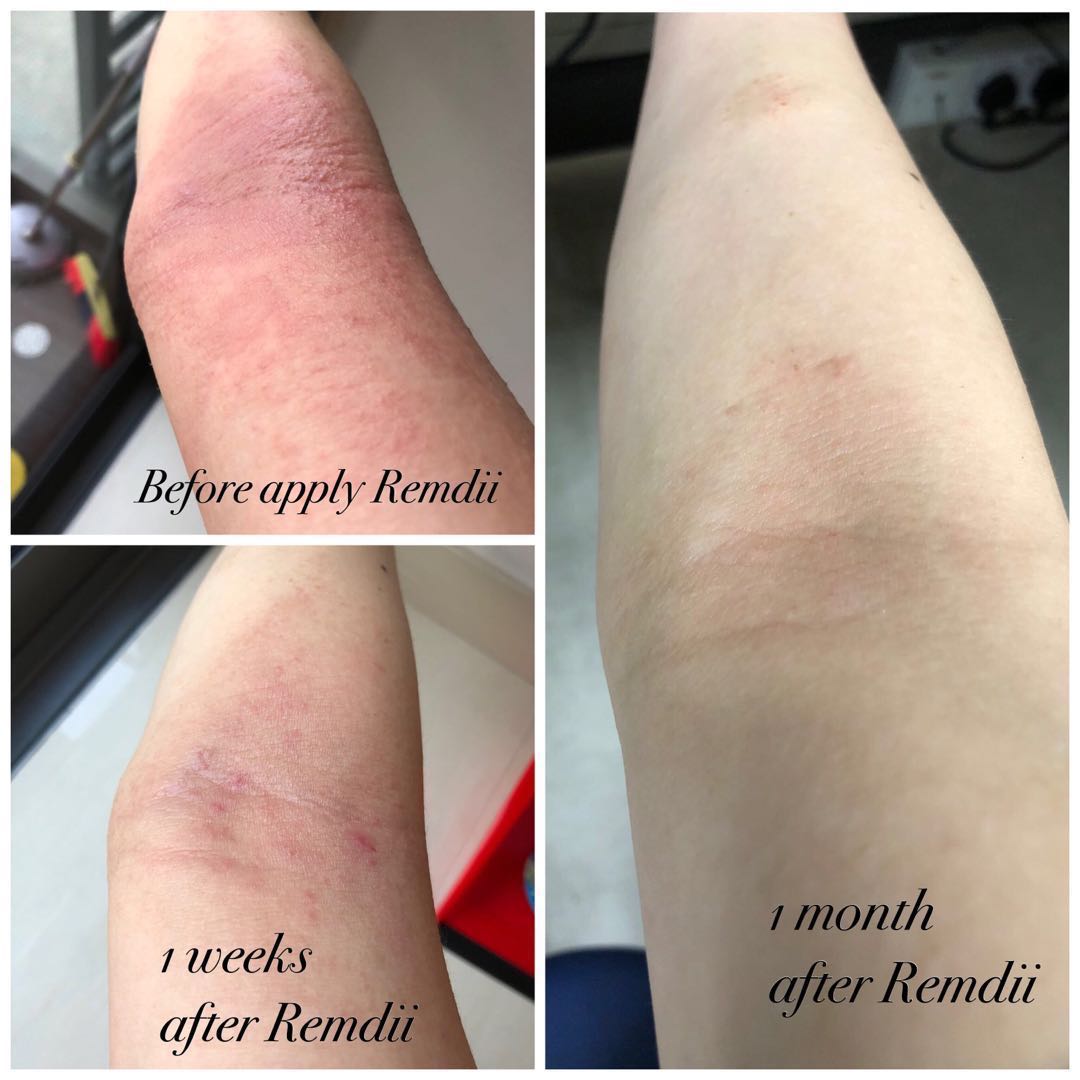 remdii eczema