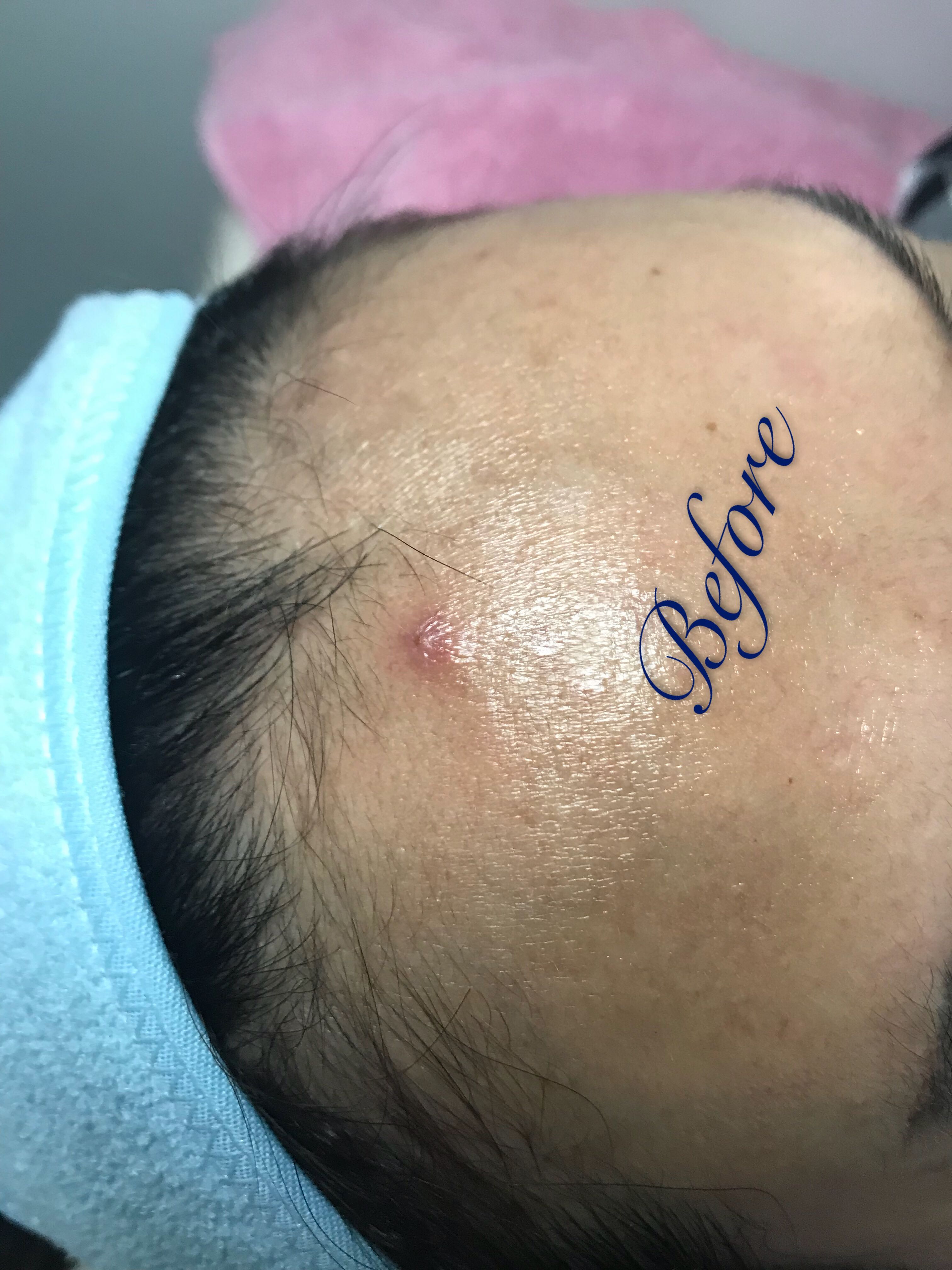 发际线hair Line Tattoo Health Beauty Hair Care On Carousell