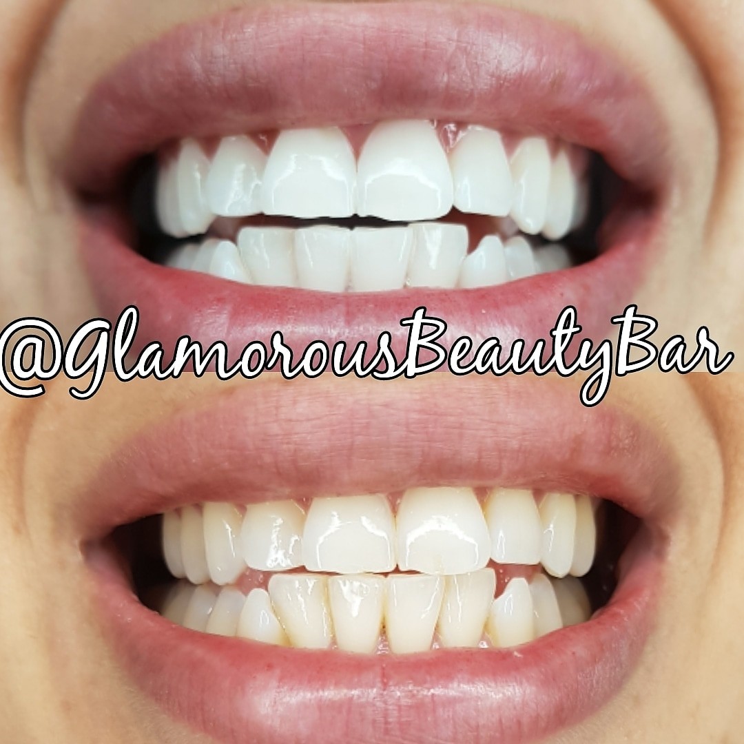 Teeth Whitening Near Me Laser - TeethWalls