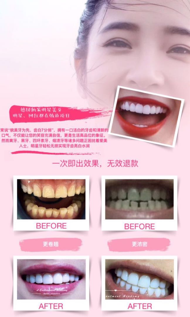 Teeth whitening, Beauty & Personal Care, Face, Face Care on Carousell