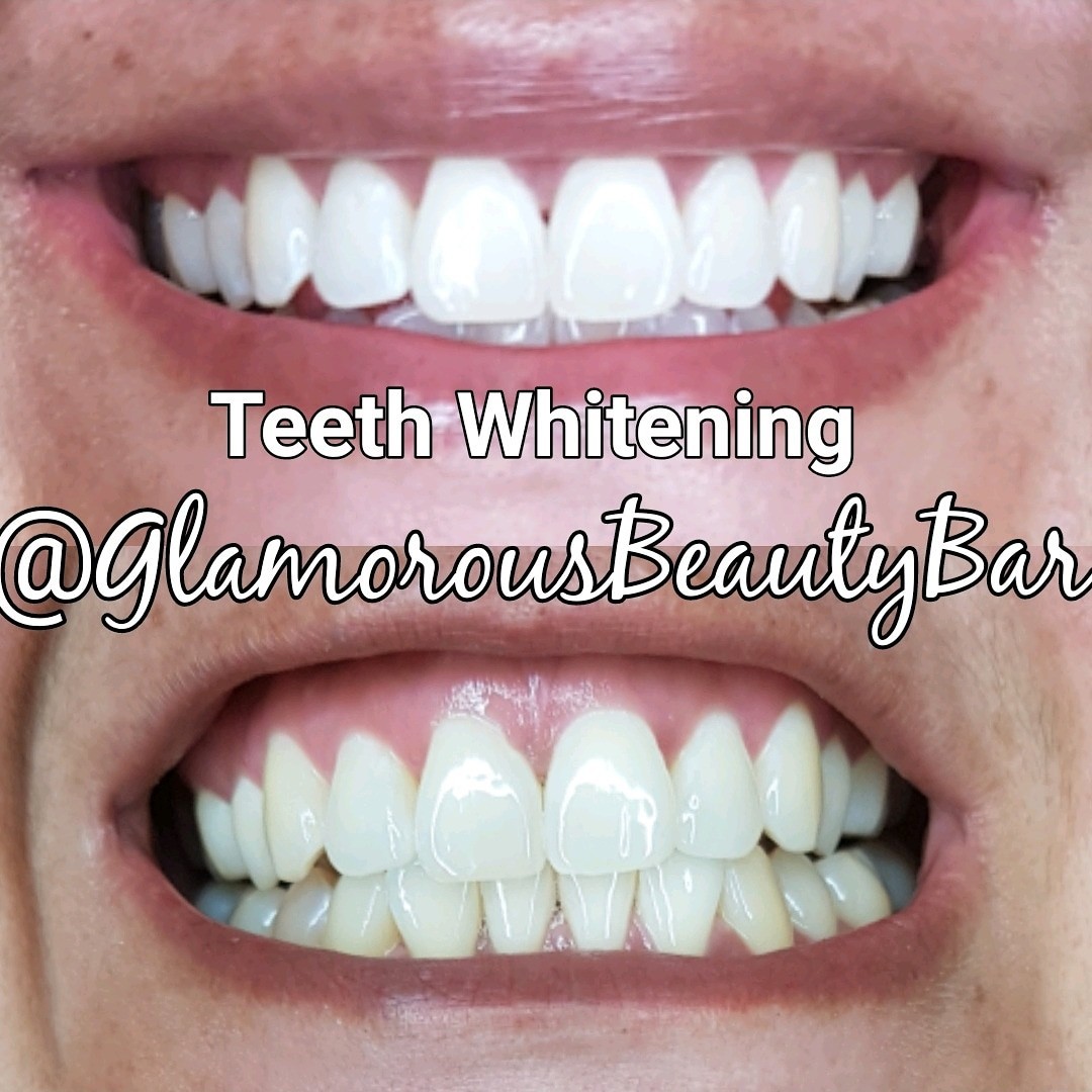 Laser teeth whitening Laser teeth whitening