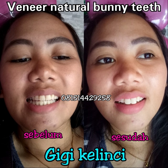 Yang Harus Anda Ketahui Jika Ingin Lakukan Perawatan Gigi Kelinci