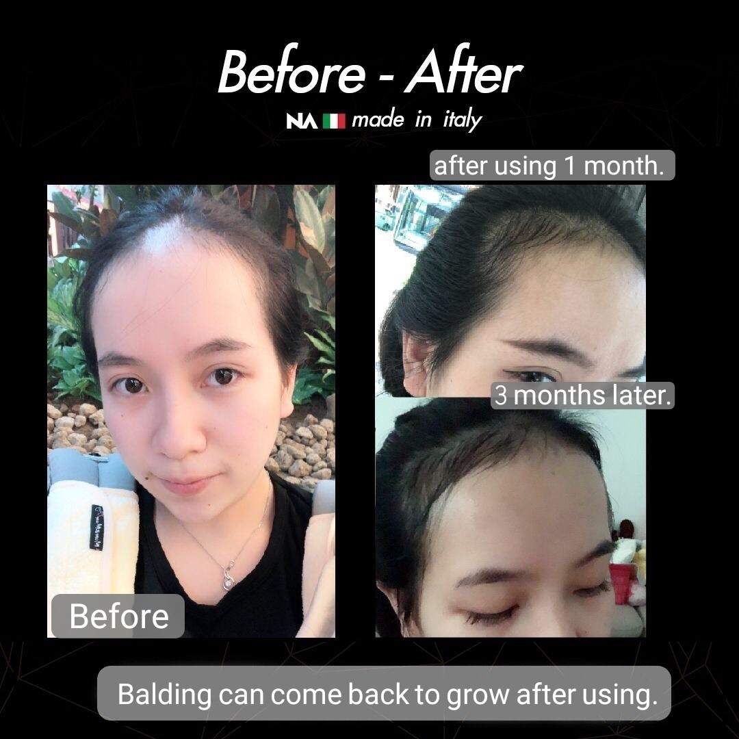 Anti Hair Loss And Hair Growth Tonic Health Beauty Hair Care