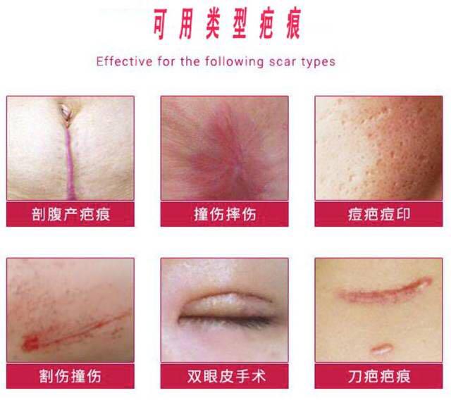 Japan top 1 MSD scar remover cream (preorder) 100 from JAPAN, Beauty