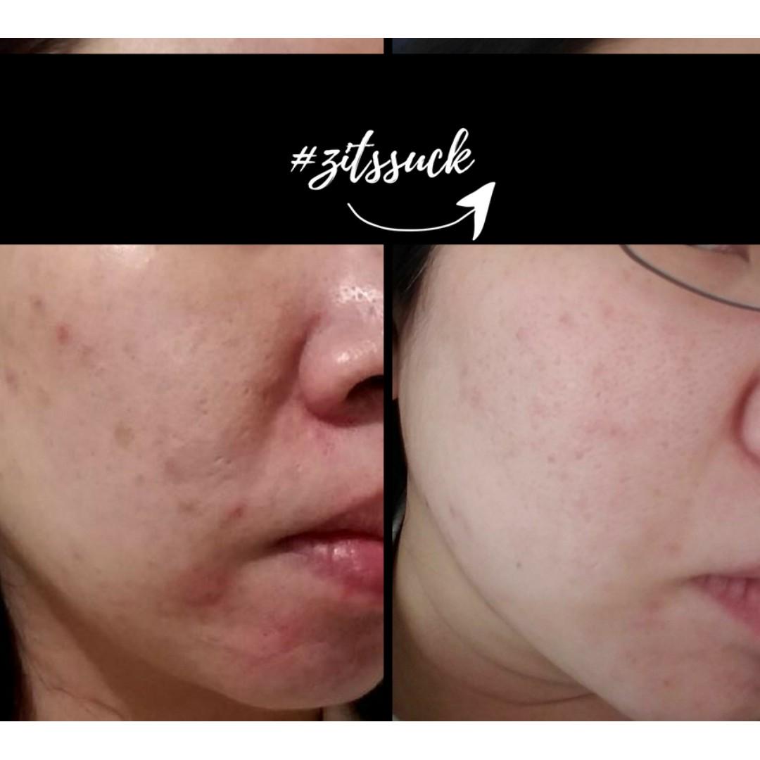 Trying Rosehip Oil For A Month For Acne Scars Youtube