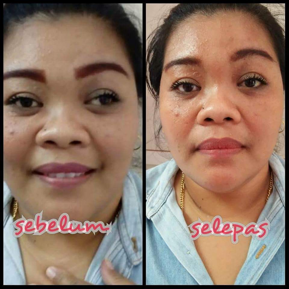 Testimoni Mata Juling Health Beauty Skin Bath Body On Carousell