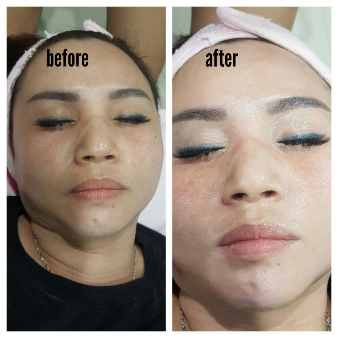 Photo Laser Treatment Plt By Steffbrow Menghilangkan Bekas Jerawat Jasa Beauty Services Di Carousell