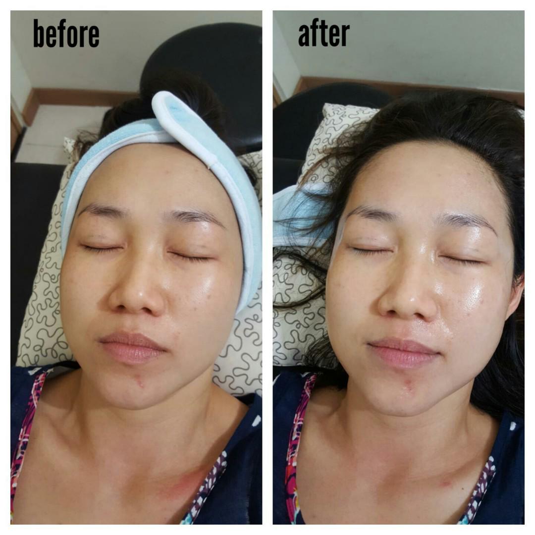 Photo Laser Treatment Plt By Steffbrow Menghilangkan Bekas Jerawat Jasa Beauty Services Di Carousell