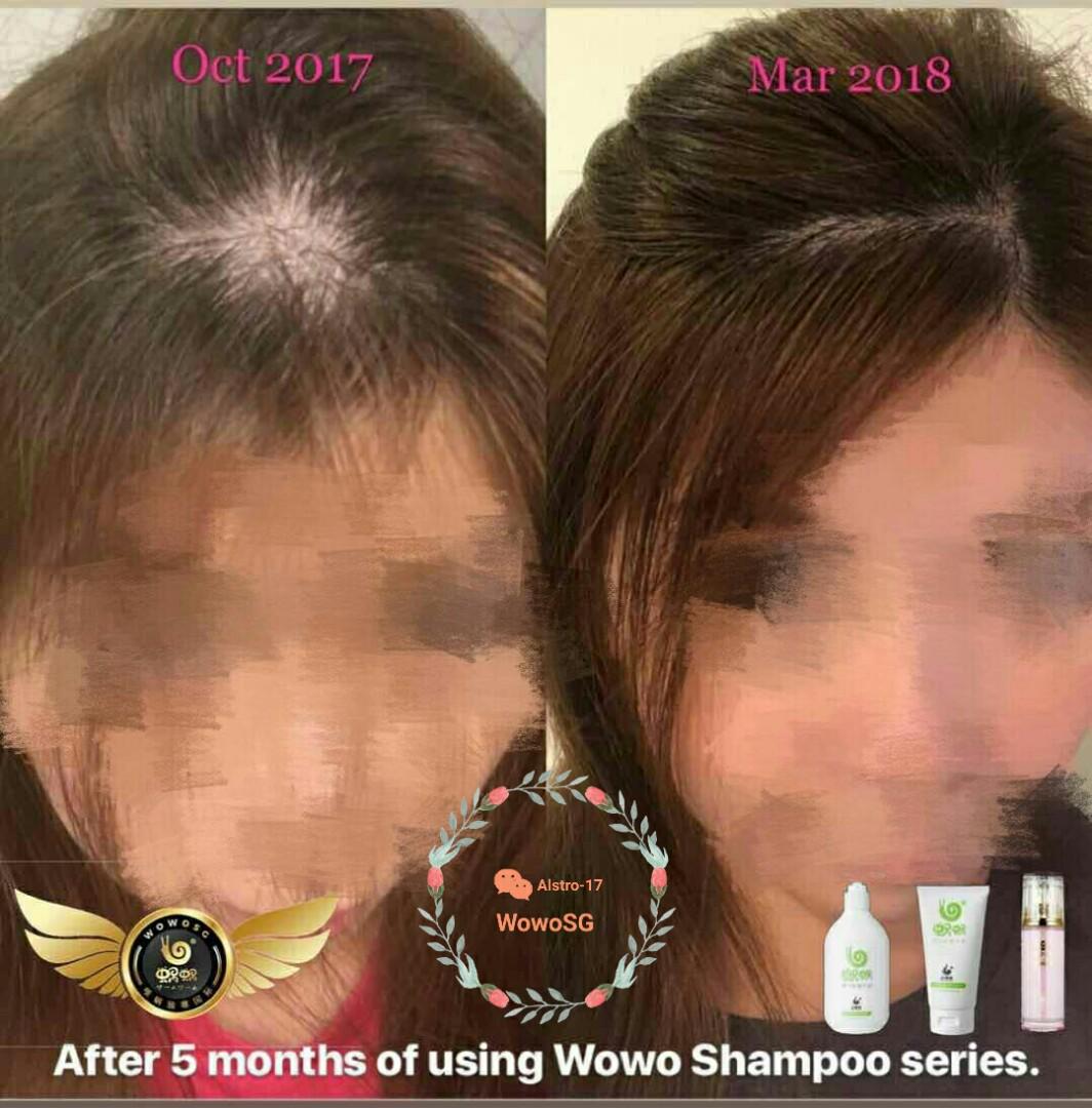 Wowo Ginger Shampoo Hair Loss Dandruff Or Oily Scalp Health