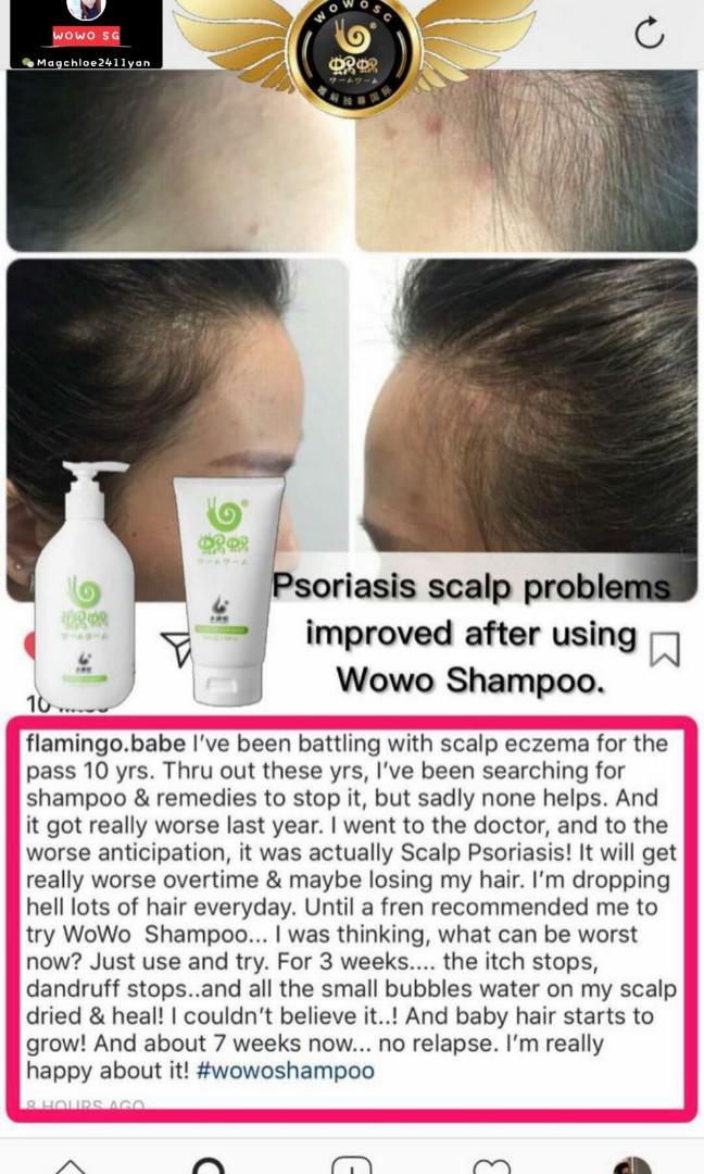 Treament Of Psoriasis Scalp Problems Health Beauty Hair Care