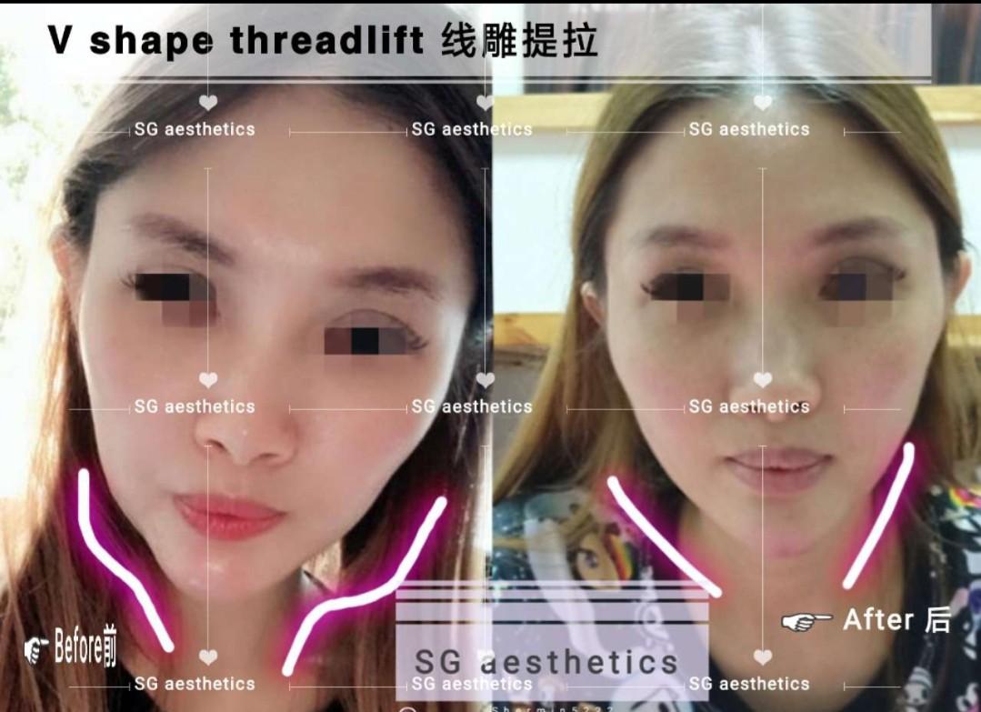 V Face Thread Lift 6thread Health Beauty Face Skin Care On Carousell