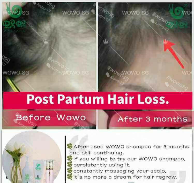 Wowo Ginger Shampoo Confinement Or Post Natal Hair Loss Babies