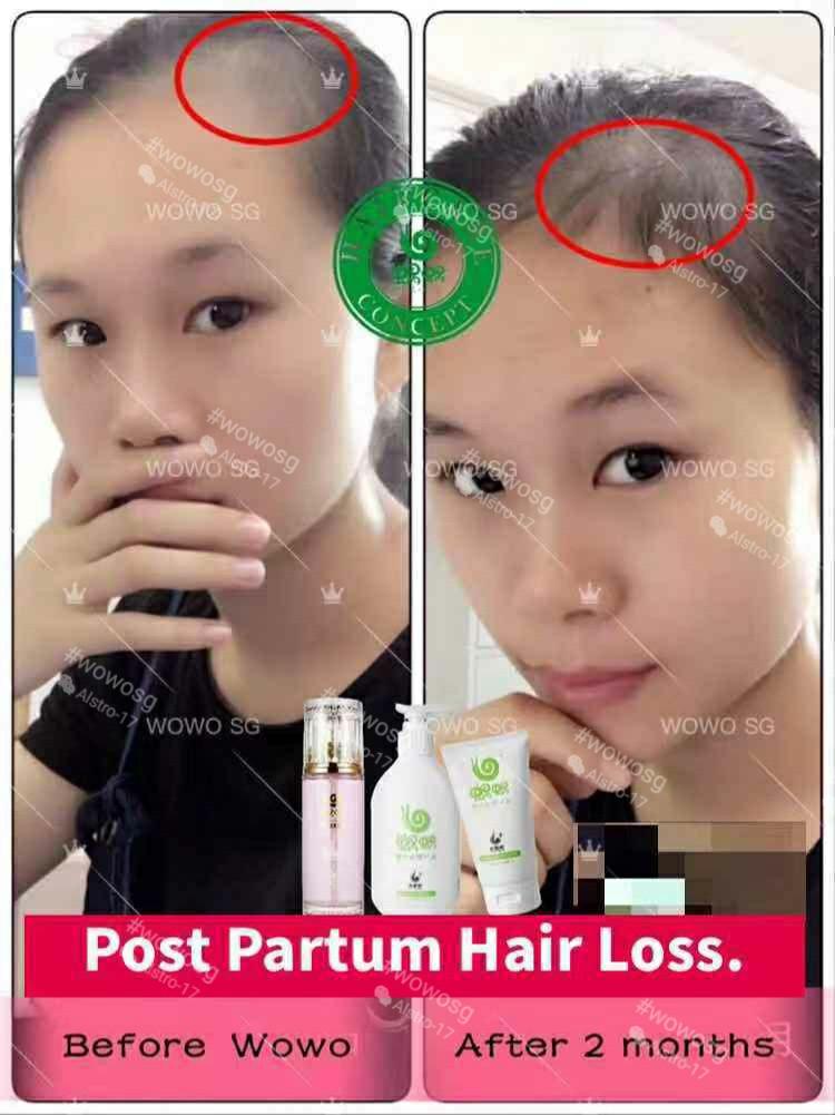 Wowo Ginger Shampoo Hair Loss Dandruff Oily Scalp Health