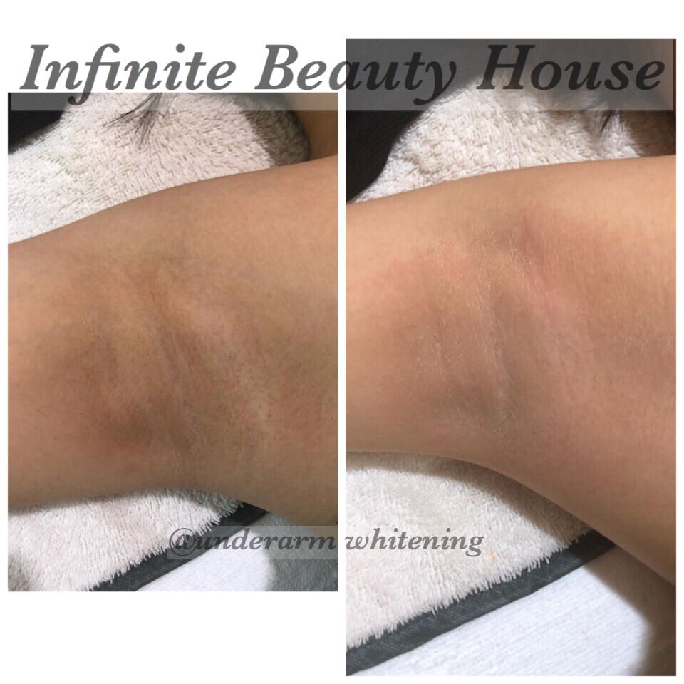 effective underarm whitening treatment