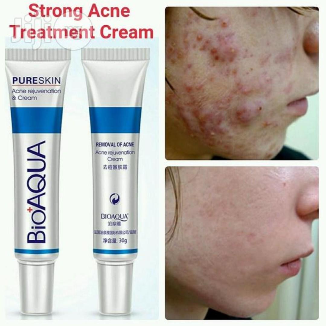 bioaqua acne cream reviews