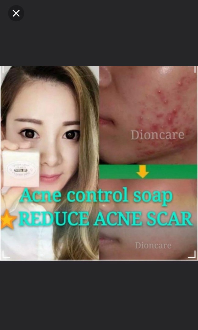 soap for acne scar