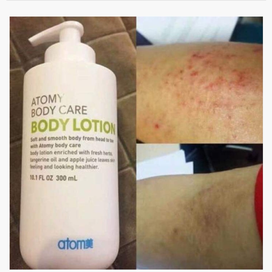 body lotion for itching