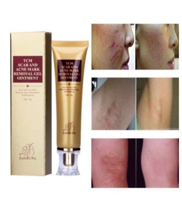 face ointment for acne